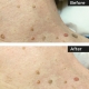Skin Tags, Seborrhoeic Warts