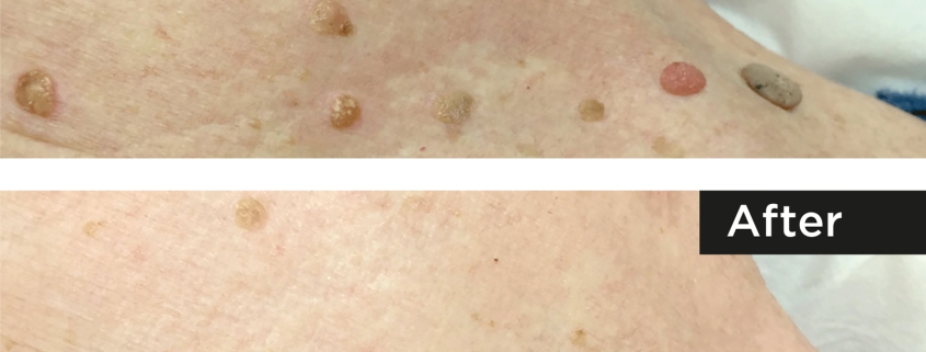 Skin Tags, Seborrhoeic Warts