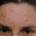 acne_before