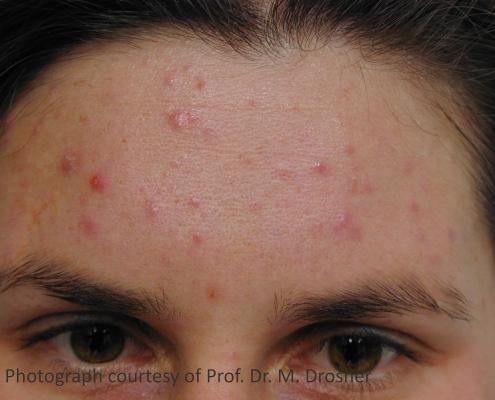 acne_before