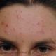 acne_before