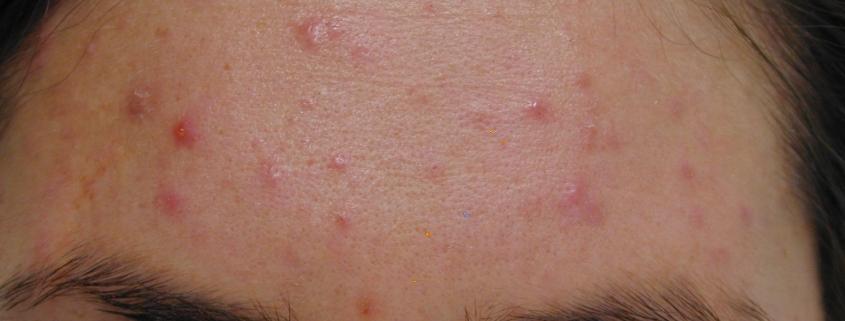 acne_before