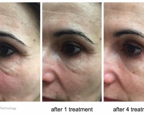 Course-of-4-under-eyes-eyebrows-lifting.