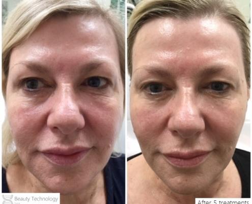 Redness-Lifting-under-eyes