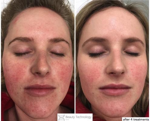 Rosacea-and-Psoriasis-on-hairline