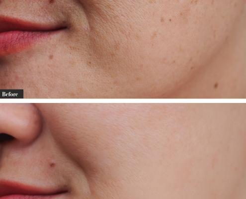Pigmentation