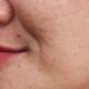 Pigmentation