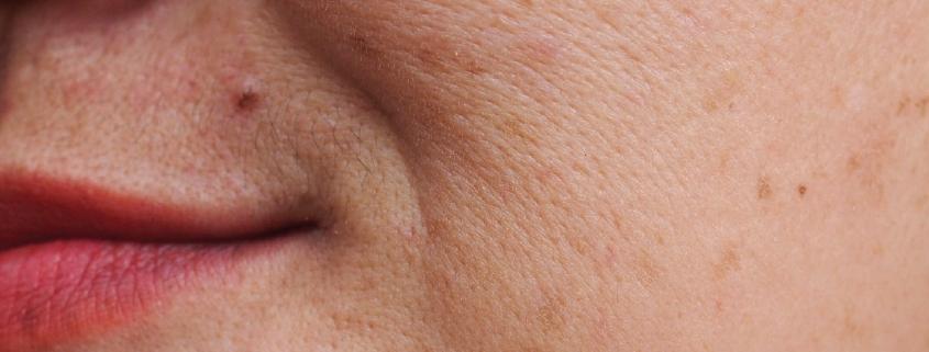 Pigmentation