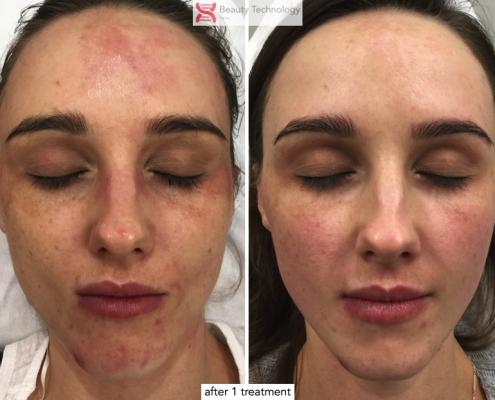 chemical peel after