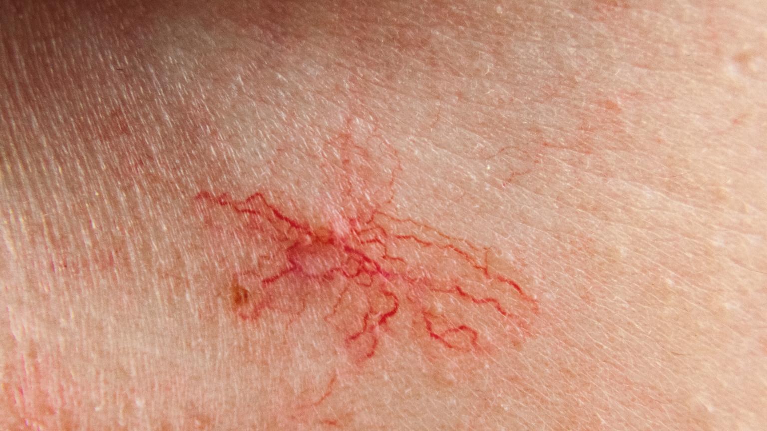 Understanding Broken Veins Hough Green Clinic