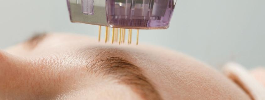 Unveiling the rejuvenating magic of microneedling
